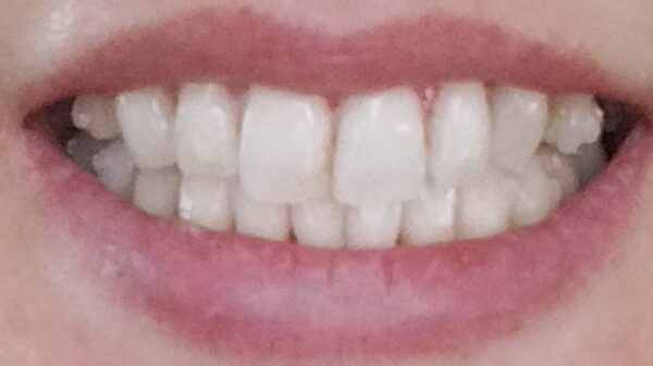 アライナー2枚目