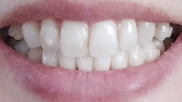 アライナー3枚目