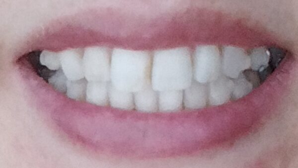 アライナー4枚目